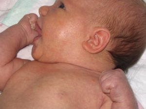 Потница у новорожденных фото