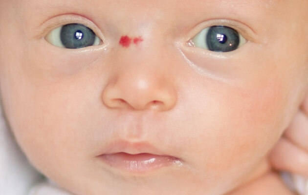 гемангиома на лице у новорожденного