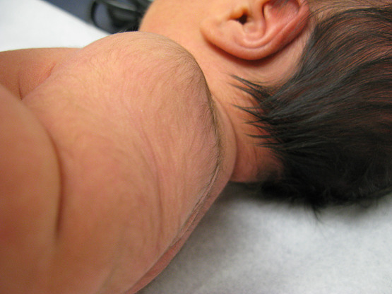 волосы на теле новорожденного