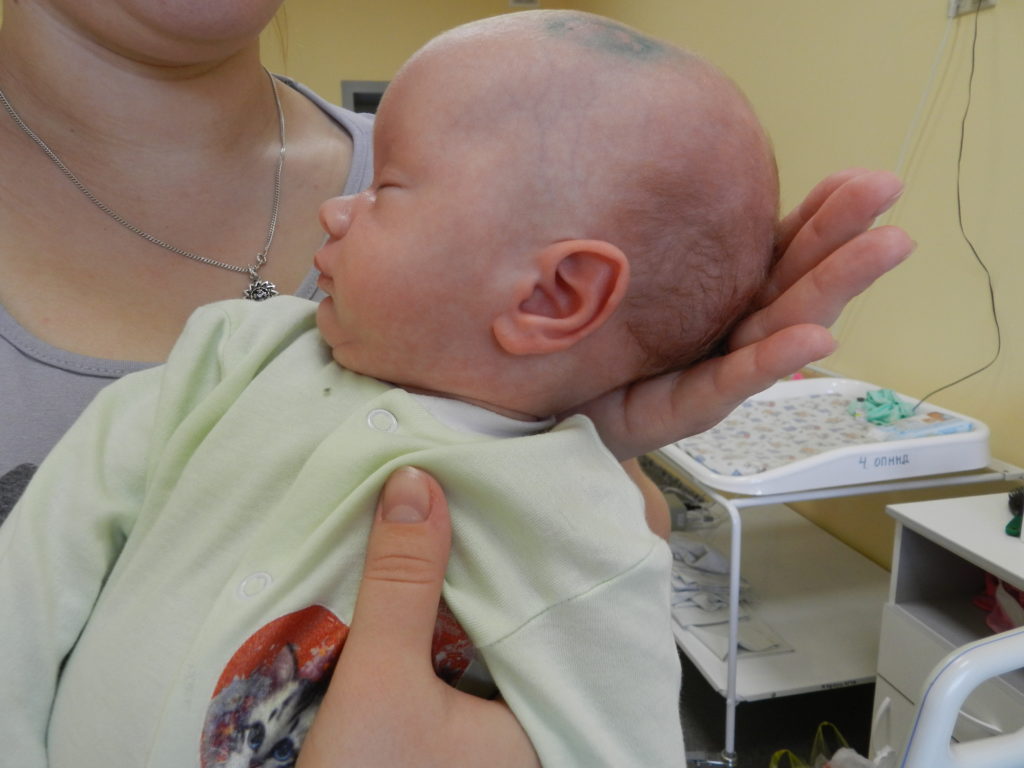 гидроцефалия у новорожденного фото