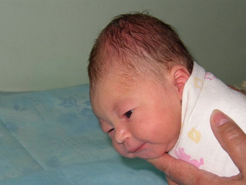 Невус унны у новорожденного фото