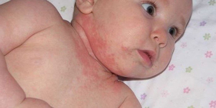 пищевая аллергия на лице у ребенка