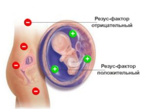 гемолитическая болезнь новорожденных причины