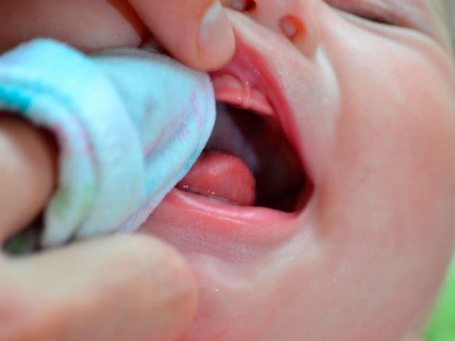 Обработка полости рта младенца при стоматите