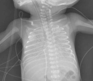 снимок рентген грудничку