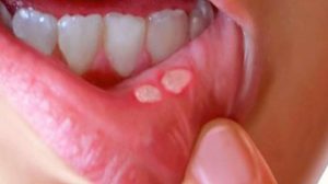 Язвочки во рту как следствие стоматита