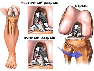 Надрыв мениска коленного сустава фото