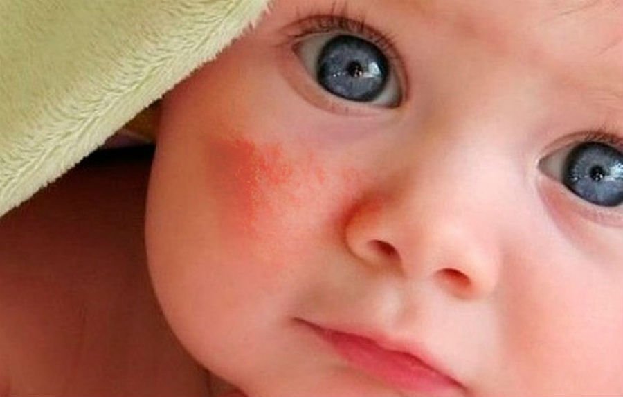 причины покраснения щек у младенца: способы лечения